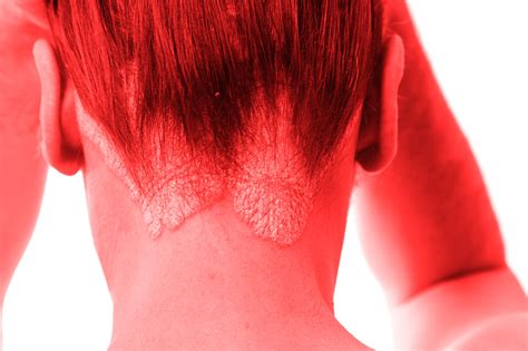 Red Light Therapy for Psoriasis - What the Science Says – RLT Home