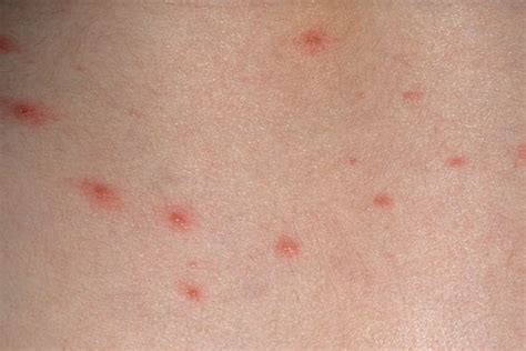 Chicken Pox in Babies and Toddlers | Signs, Symptoms & Treatments ...