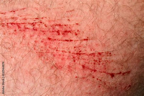 Scratch skin, wound or cut on the skin, red blood. Hairy part of a man body close-up Stock Photo ...