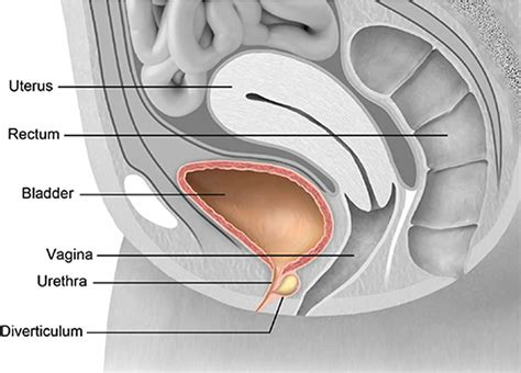 Urethral diverticulum definition, causes, symptoms, diagnosis & treatment