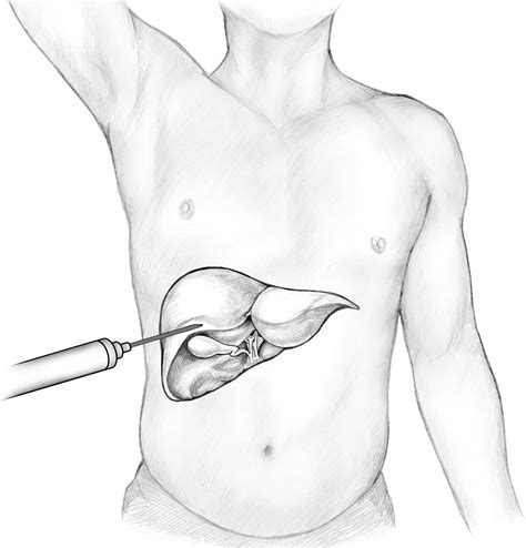 NASH Diagnosis: Liver Biopsy Basics - The NASH Facts™ Project