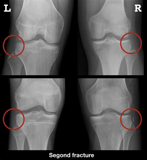 Segond fracture • LITFL Medical Blog • Medical Eponym Library