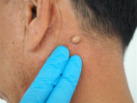 What is a Sebaceous cyst? - Diamond Skin Care