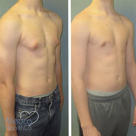 Gynecomastia Surgery | Medco Healthco | Stay Safe and Healthy