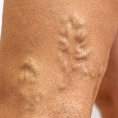 Everything to know about varicose veins in pregnancy | Specialist Vein Health