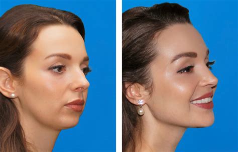 High Cheekbones vs Low Cheekbones in Men & Women: How to Get a Defined and Prominent Cheekbones?