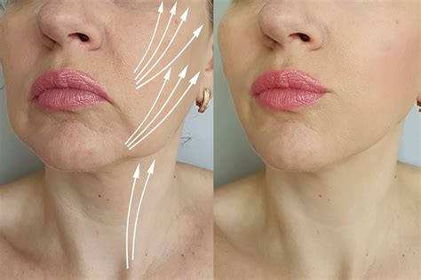 Mini vs. Full Facelift: Choosing the Right Procedure for You