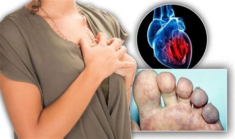 Heart attack symptoms: Signs of heart disease include having blue skin | Express.co.uk