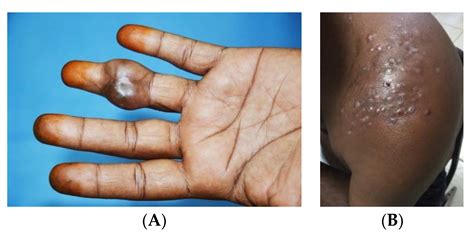 TropicalMed | Free Full-Text | Mycetoma: The Spectrum of Clinical Presentation