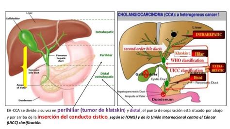 Tumor de Klatskin - Colangiocarcinoma Hiliar