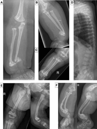 P4HB recurrent missense mutation causing Cole-Carpenter syndrome | Journal of Medical Genetics