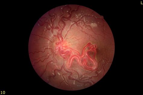 Racemose Hemangioma - Retina Image Bank