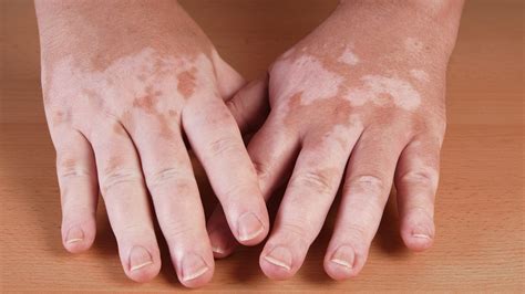 White Spots On Skin | Images and Photos finder