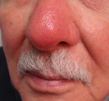 Dermatological conditions of the nose. | Dermatology Games