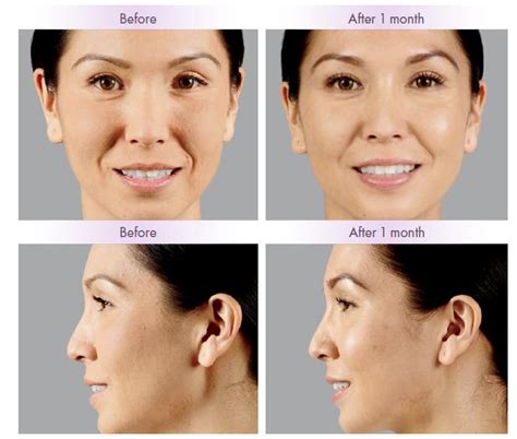 Juvederm Before & After Photos, Juvederm Costs & Side Effects