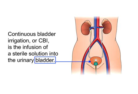 PatEdu.com : Continuous Bladder Irrigation