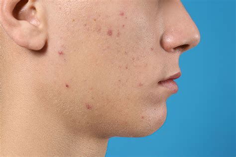 What Causes Scabs on Face and How to Treat Them