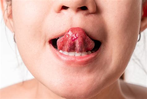 How To Get Rid Of Tongue Blisters - Staybite11