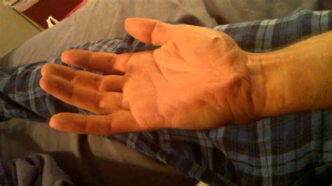 Painful fasciculation. Spasms palm of hand - YouTube