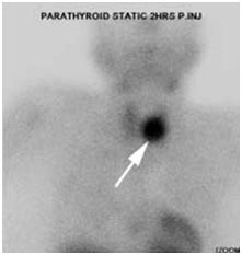 Dual Parathyroid Pathology; A Common Failure of Technetium-99 Sestamibi Scan for Preoperative ...