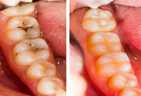 What Is a Cavity? What Causes Rotten Teeth? | MDA