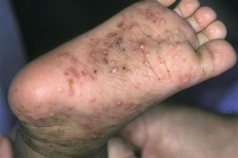 Limited Examination Detects Scabies With High Sensitivity - Dermatology ...