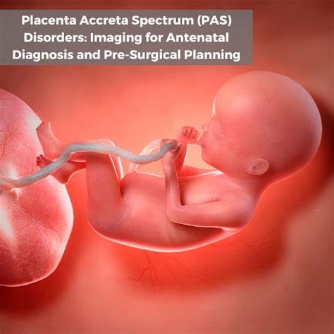 Event- Placenta Accreta Spectrum Disorders