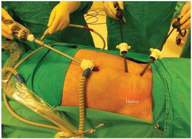 Inguinal Hernia Repair: Laparoscopy Or Open? - Halterman Orpostance