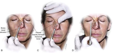 Nasal Fractures | Pocket Dentistry