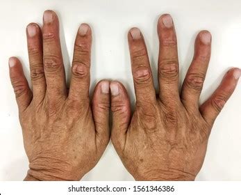 3 Palmar Plantar Erythrodysesthesia Images, Stock Photos, 3D objects, & Vectors | Shutterstock