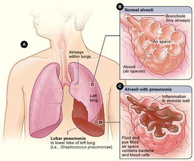 Causes - Pneumonia