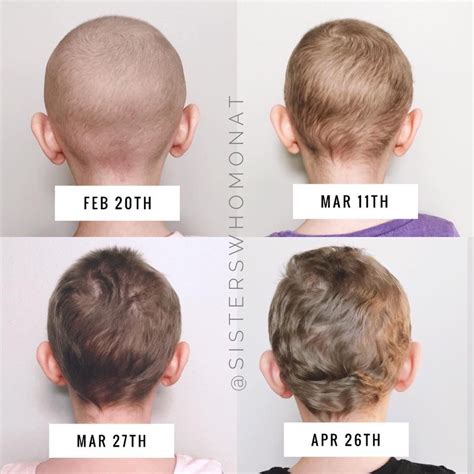 How long after chemo lose hair | hairstyles6g