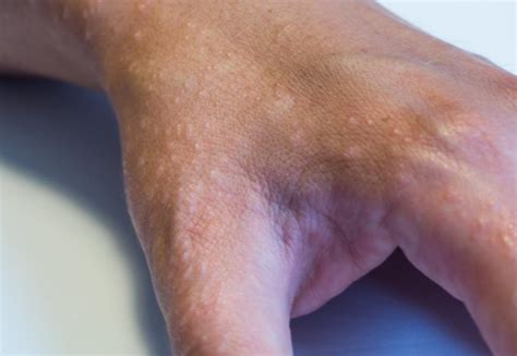 6 types of eczema: Symptoms and causes
