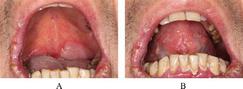 Diagnosis of oral syphilis remains a challenge – A case report ...