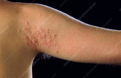 Cutaneous larva migrans rash on upper arm - Stock Image - M200/0043 - Science Photo Library