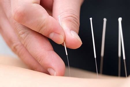 Acupuncture near me Langley,BC | Belmont Physiotherapy in Br… | Flickr