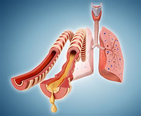 Pulmonary Rehabilitation for Patients With Long COVID - Pulmonology Advisor