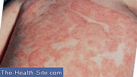 Skin Fungus: Contagion, Signs, Healing 💊 Scientific-Practical Medical Journal - 2024