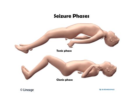 Seizures | USMLE Strike | 100% Best Explanation | 2023