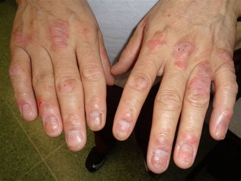 Psoriasis On Knuckles