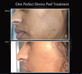 The Perfect Derma Peel | Beautycall