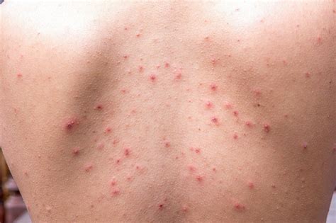 Chicken Pox Scars | Conditions - The Clinic Room – theclinicroom