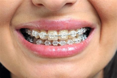 Things Your Orthodontist Won't Tell You | The Healthy