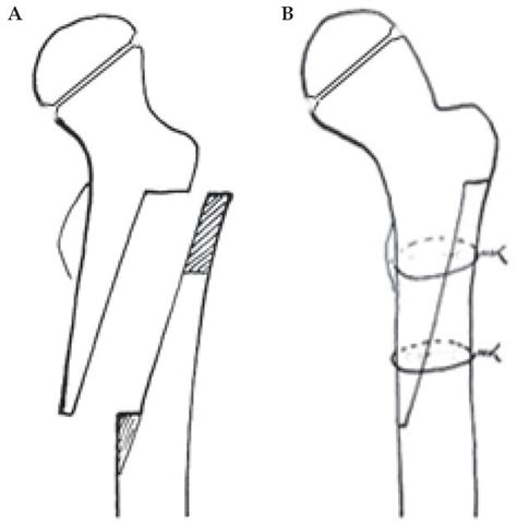Review Outcome of Combined Open Reduction and Femoral Shortening Osteotomy for Developmental ...