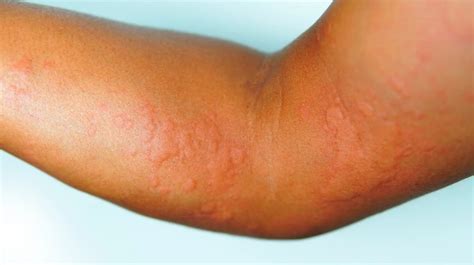 Common Skin Rashes And What To Do About Them, 49% OFF