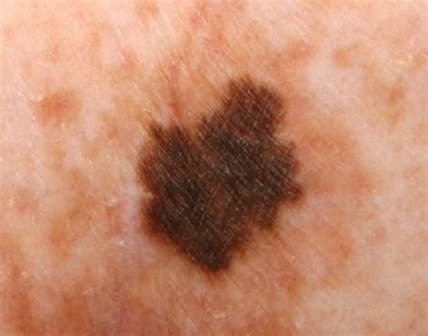 Can a Lentigo Turn into Melanoma? — Scary Symptoms