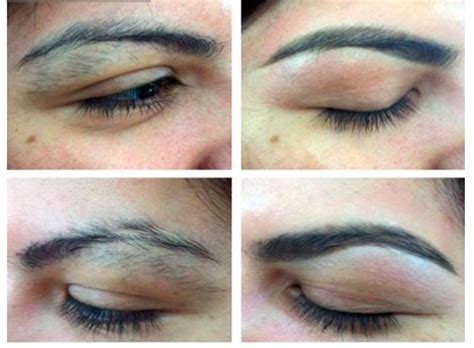 Eyebrow laser hair removal - Houston, TX | Hair Removal Treatment