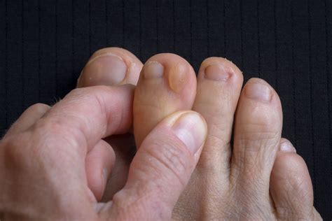 Blisters on Toes: Causes and Treatments