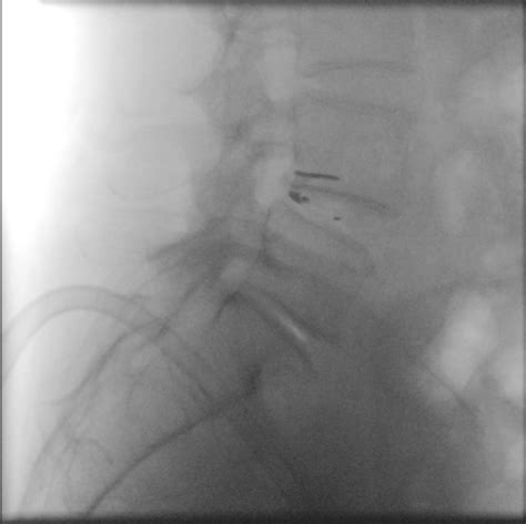 Dr. Stieber Performed the first Barricaid Anular Closure Device Surgery ...