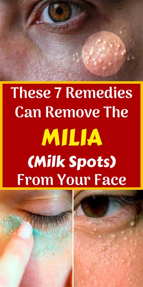 These 7 Remedies Can Remove The Milia (Milk Spots) From Your Face